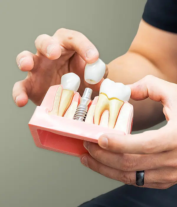 Dental crown model showing restorative treatment options