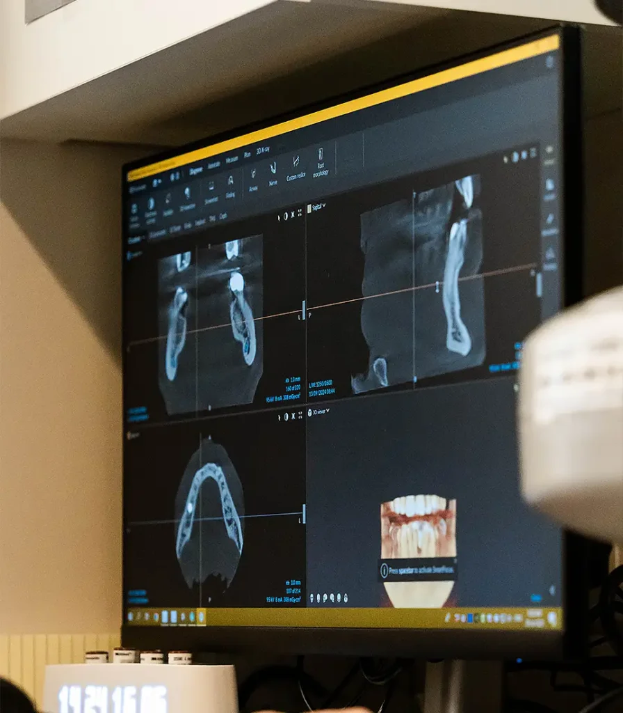 CBCT 3D imaging scan displayed on a computer screen at Landmark Dental in Regina